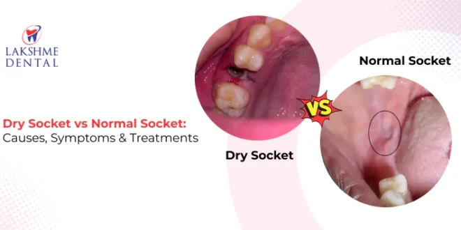 Dry Socket vs Healthy Socket: Symptoms Explained